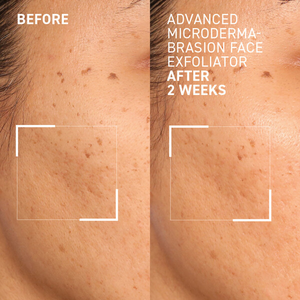 Advanced Microdermabrasion Face Exfoliator (Bild 3 av 4)