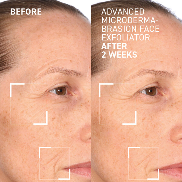 Advanced Microdermabrasion Face Exfoliator (Bild 4 av 4)